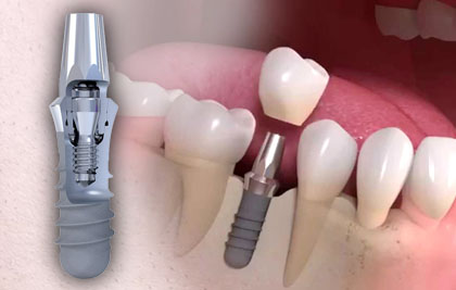  IMPLANTS DENTALS Straumann®