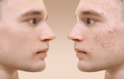  EL QUE HAS DE SABER DE L’ACNE