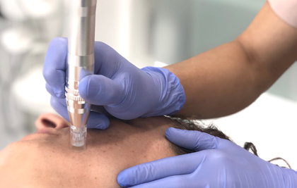  MICRONEEDLING amb m.pen [PRO], el tractament que exercita la teva pell